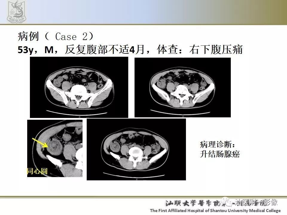 肠套叠的影像表现