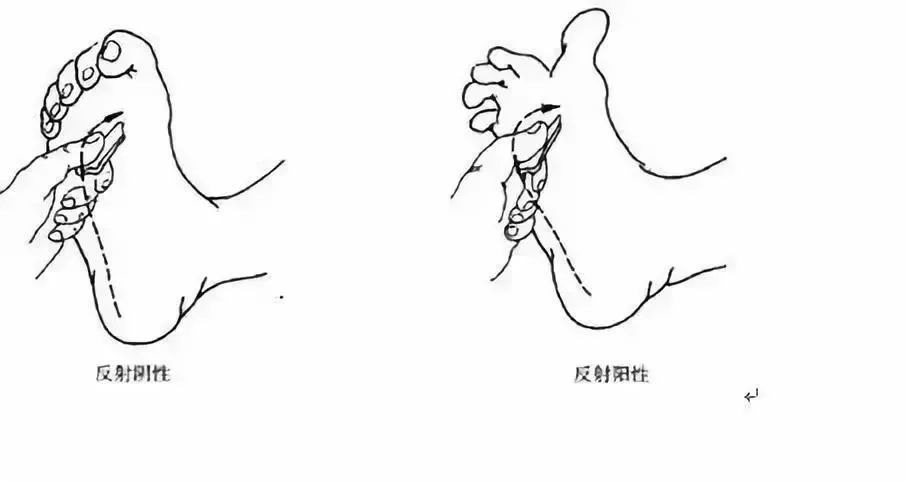 2,babinski等位征chaddock 征oppenheim 征gordon征gonda 征pussep征3