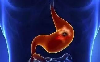 做胃镜到底有多难受?多久做一次合适?一次性