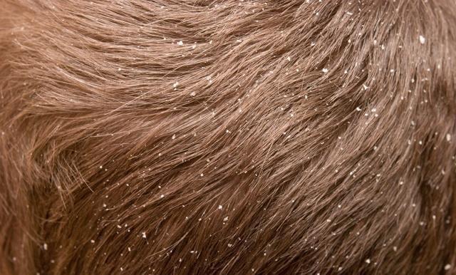 自然摆脱干燥头皮的头皮屑