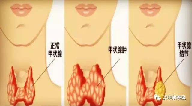 理疗 食疗 甲状腺病de调理 典藏版 腾讯网