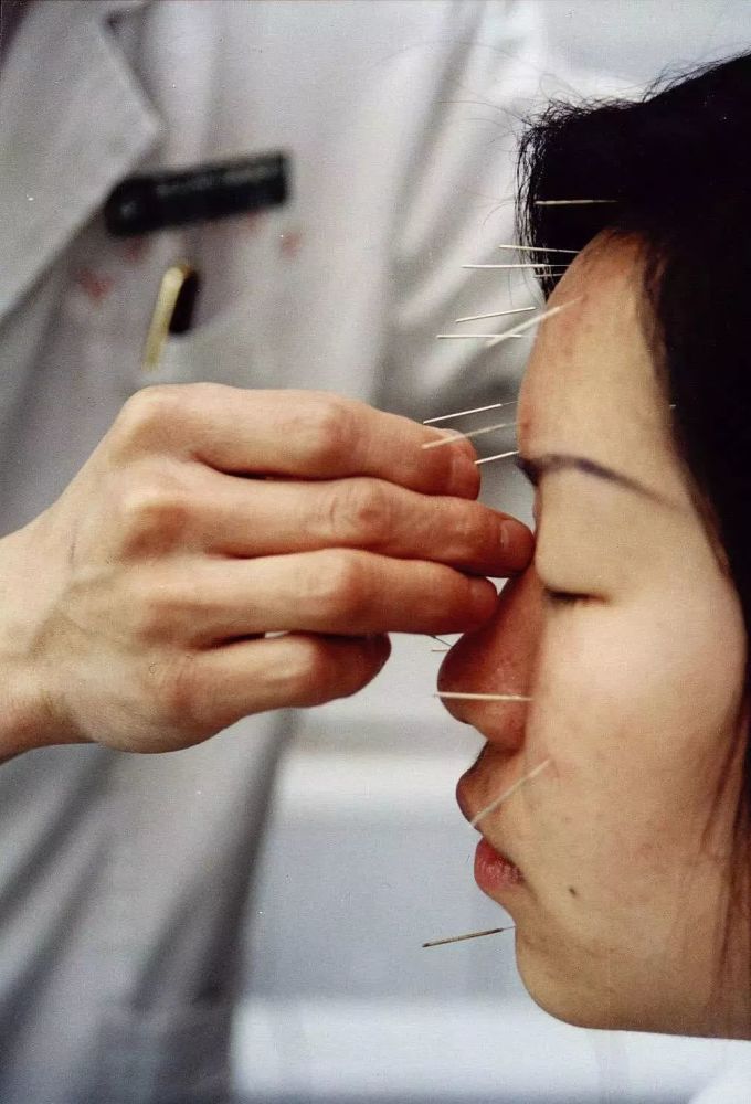 男子美容院扎针灸致脑出血,但这口黑锅针灸不
