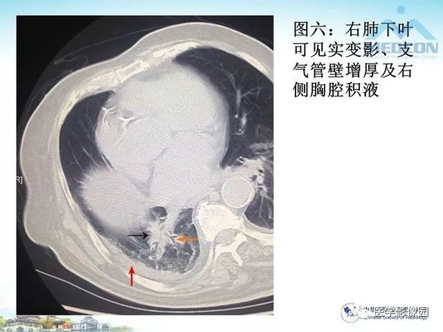 克雷伯桿菌肺炎