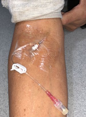 下图中的患者,在放射科做好增强ct检查后返回病房,留置针穿刺部位在肘