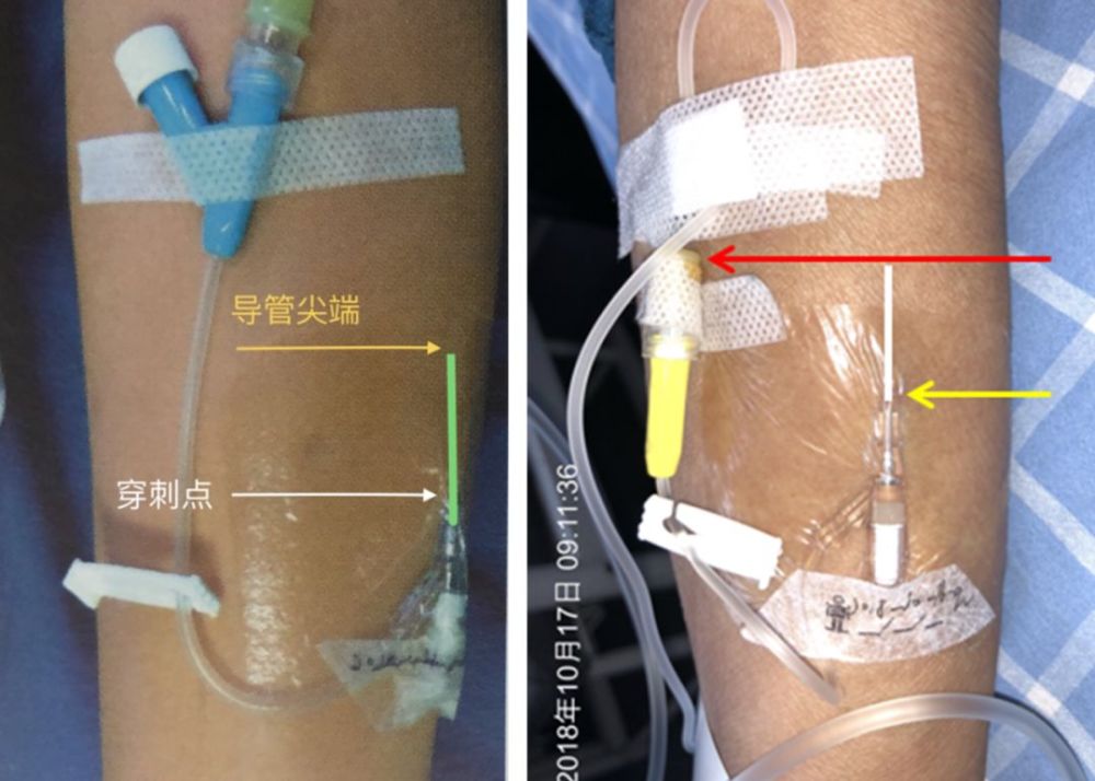 儘管肝素帽/接頭的位置高於導管尖端不一定能保證完全沒有回血,但能