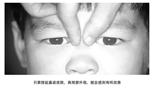 你的孩子是否患有斜视?这份简单测试法请收好!