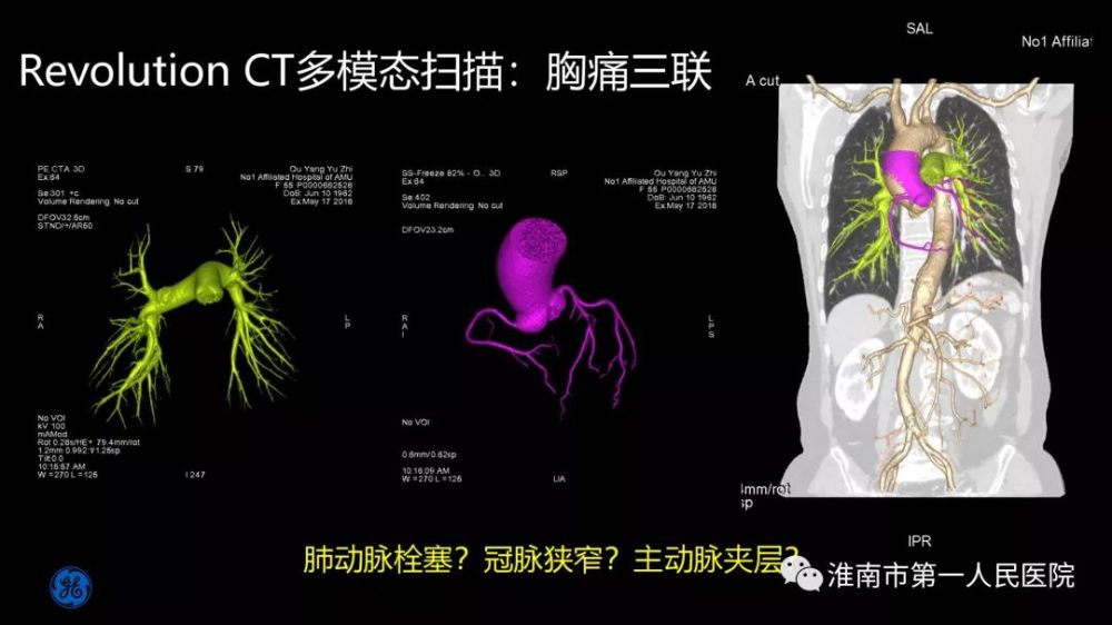 GE256排超高端螺旋CT 落户市一院