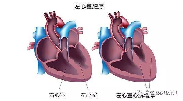 临床实用心电图入门第十讲左室肥大