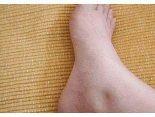 尿酸|36岁男子，尿酸高达850，突发肾衰竭入院，这2种东西害人不浅