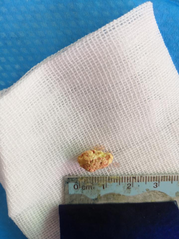 发现他口腔内右侧舌下区肿胀,将舌抬起,触诊疼痛明显,右侧颌下腺导管