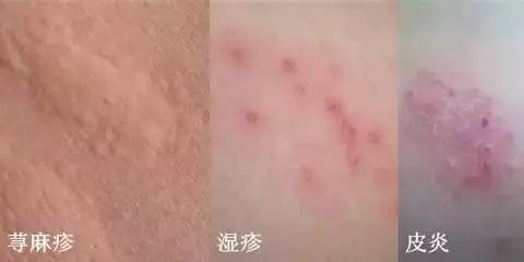 肤康 科普 全身痒是怎么回事 挠了还起红疙瘩 腾讯新闻