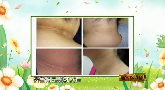 孩子的脖子发黑要警惕是黑棘皮症建议他带孩子去内分泌科看看小心孩子