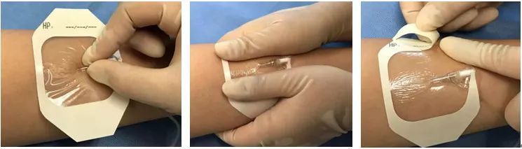 要点 1:贴膜封闭隔离塞提醒:贴膜要将留置针针座部分全部覆盖,以形成