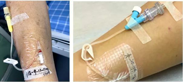 真人示范7大留置针固定要点操作考试必掌握