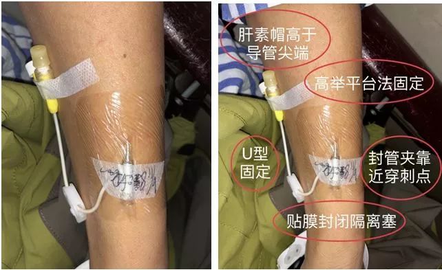 真人示范7大留置针固定要点操作考试必掌握