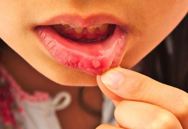 为什么唇炎会偏偏找上你 3个原因告诉你答案