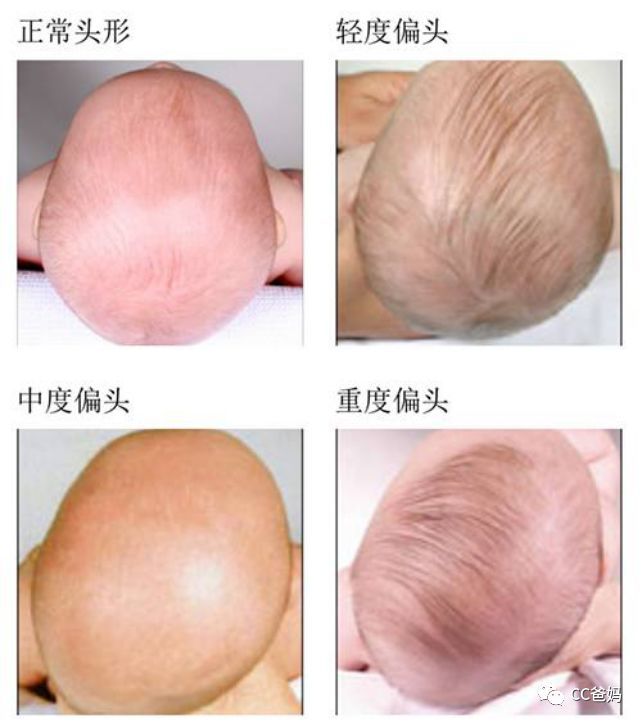 宝宝头睡偏了会影响脑部智力发育?如何有效预