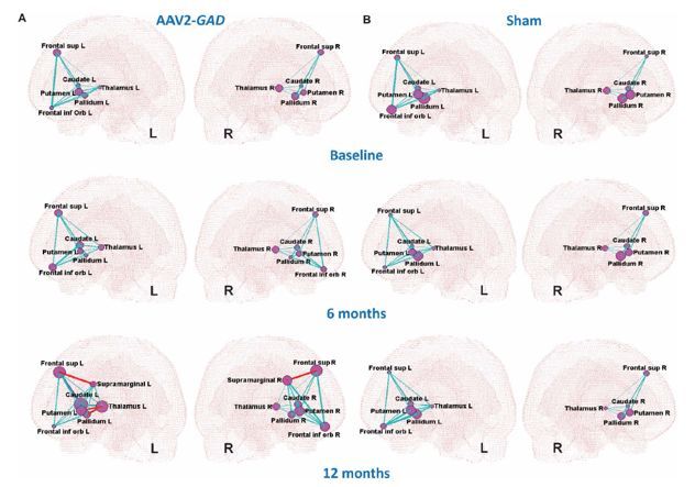 重磅!《Science》子刊:有望从基因层面治愈帕金森病
