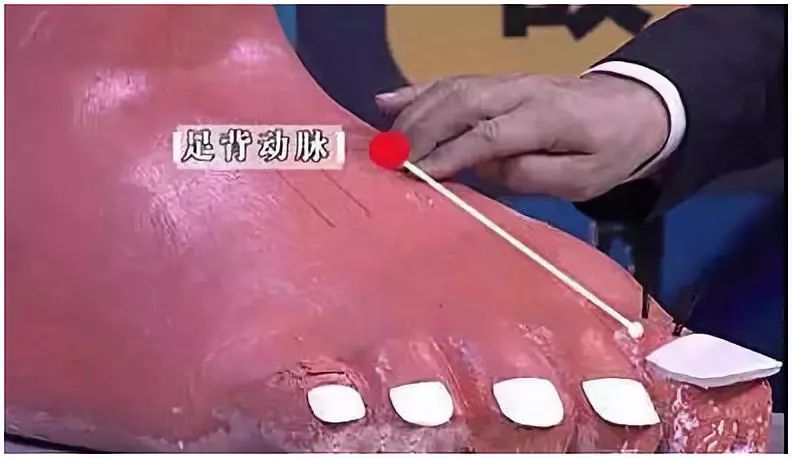 万万没想到腿麻竟也能要命