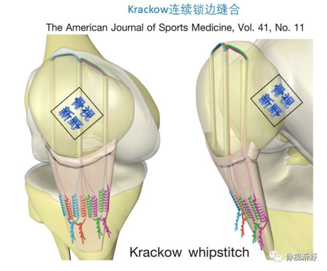 【骨科小技巧】髌韧带撕脱的krackow及其改良缝合方法!