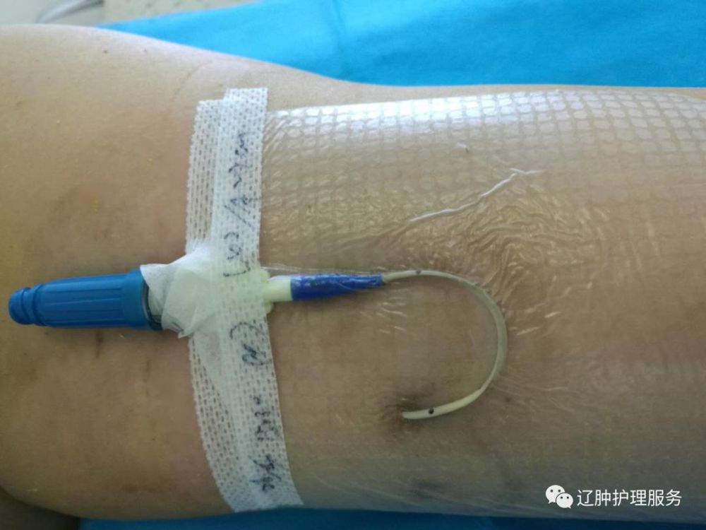 picc0揭敷料Ω固定法好经验快收藏