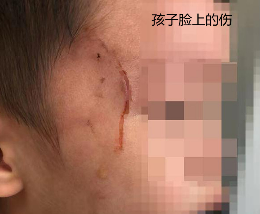 3歲男童被老師手鐲劃傷面部,家長索賠15萬遭拒絕!