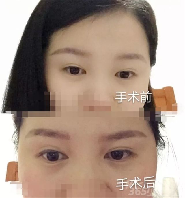 单女士手术前后对比
