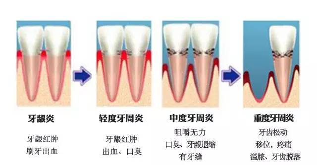 4.    牙齿松动,牙周组织支持力量大为减弱时,就会导致牙齿松动.