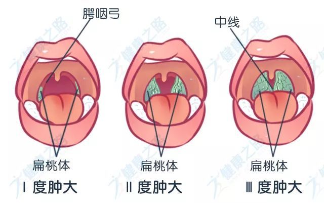 扁桃体肿大程度示意图