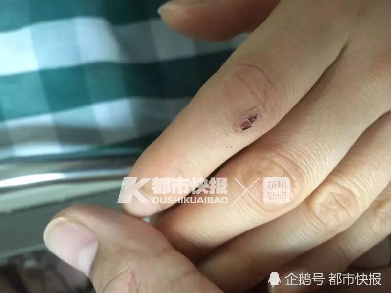 浙江23岁姑娘养银环蛇被咬 心脏骤停昏迷不醒