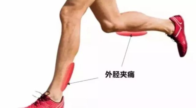 胫骨疲劳性骨膜炎