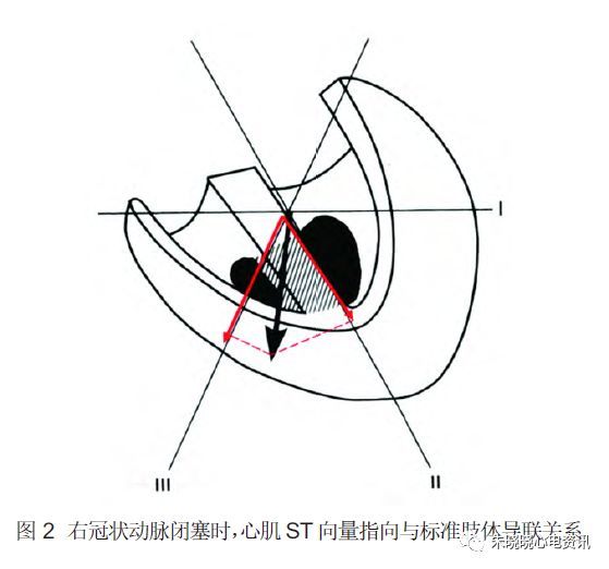 (1)右冠狀動脈閉塞引起的st 向量的改變,較左迴旋支閉塞所引起的改