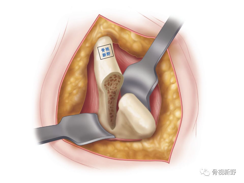 骨科小技巧如何做好取髂骨植骨术
