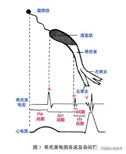 应用心导管记录希氏束电位的技术于1968 年推出,成为应用广泛,价值极