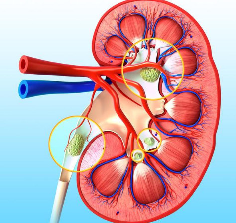 痛风分阶段,这4个阶段的痛风,你都了解吗?