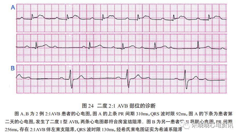 郭继鸿教授房室阻滞部位的心电图诊断