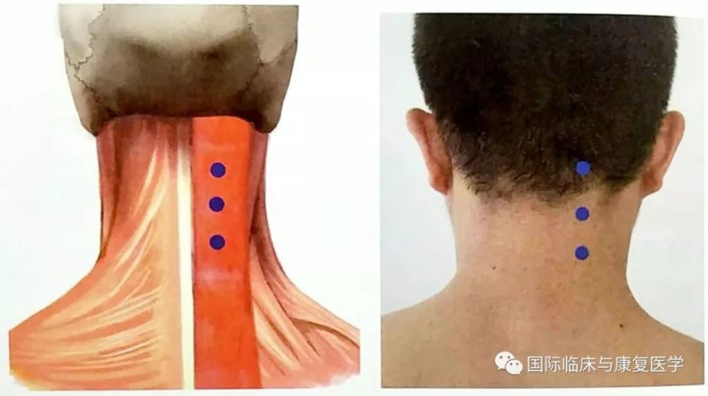 頸部常用注射部位的解剖及肉毒毒素注射方案