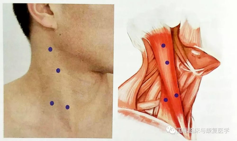 頸部常用注射部位的解剖及肉毒毒素注射方案_騰訊新聞