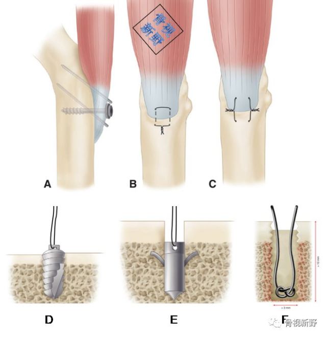 骨科精讀|圖文結合:腱-骨止點重建技術大全,趕緊收藏!