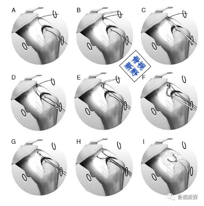 半月板拉出縫合法以下為內側半月板根部撕裂經脛骨拉出縫合方法常見