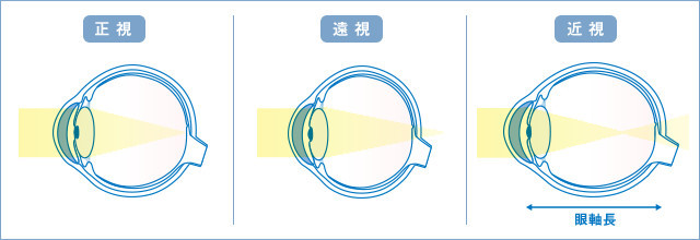 近視的眼軸 來源:日本近視研究會 myopia.jp