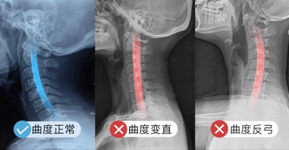 8小时缓解颈椎酸痛 这款枕头睡上比按摩还舒服