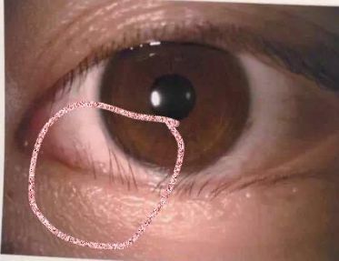 何为倒睫?能戴隐形眼镜吗?_腾讯新闻