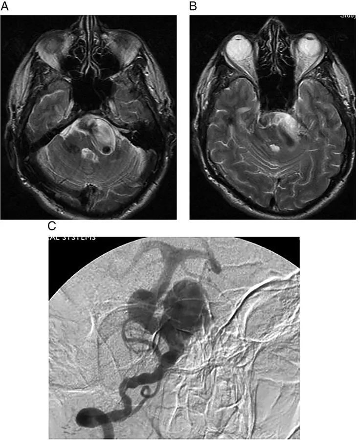15张图谱轻松掌握:桥小脑角区正常解剖及常见病变