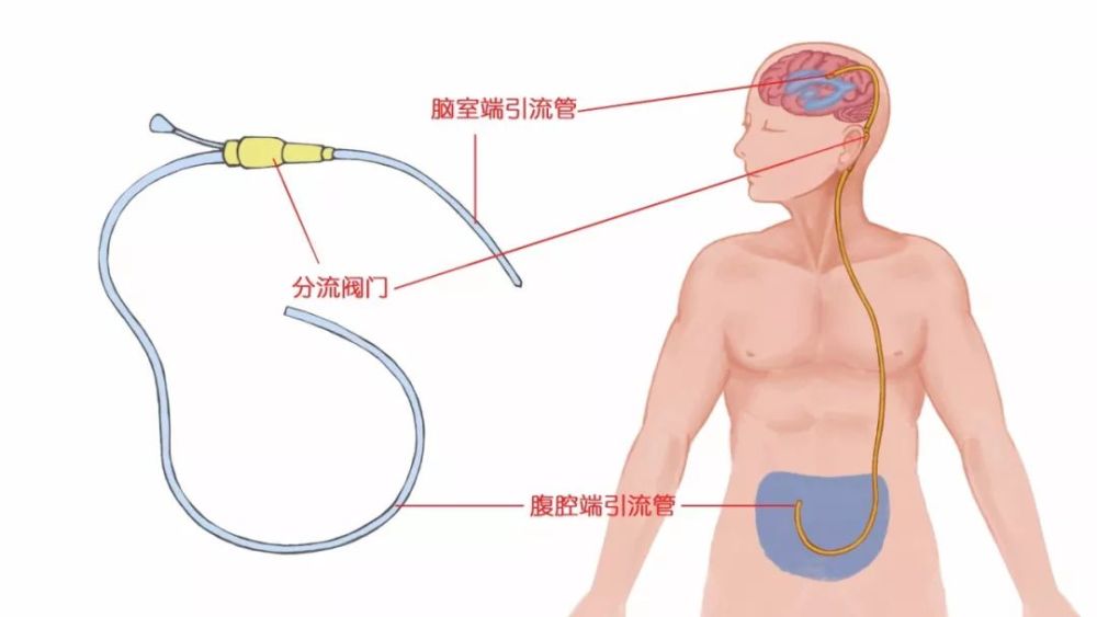 颅内肿瘤诊治前沿：从诊断到康复的全面解析