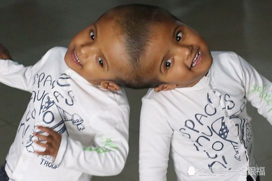 头部相连的连体双胞胎2岁半小姐妹微笑面对即将到来的分离手术