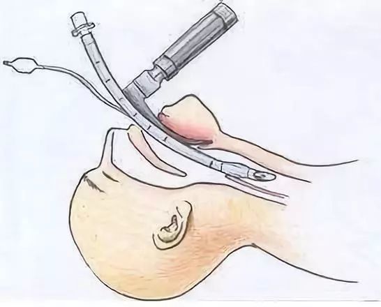 icu气管插管的护理知多少?_腾讯新闻