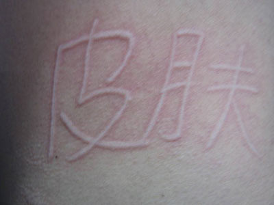 较真 | 人命关天!使用头孢前到底要不要皮试?