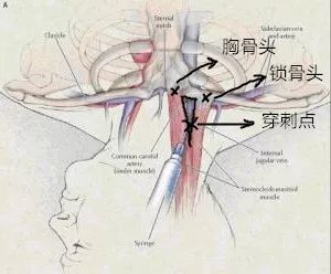 深静脉置管之锁骨下静脉穿刺,一文详解_腾讯新闻