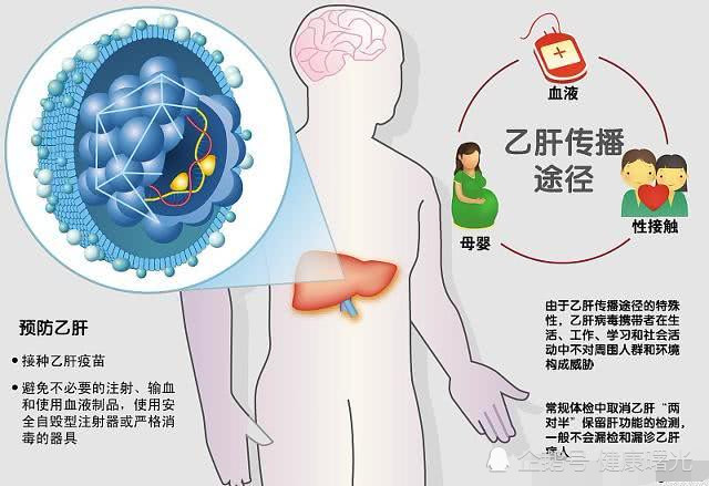 肝硬化的原因 症状和治疗 早知道早好